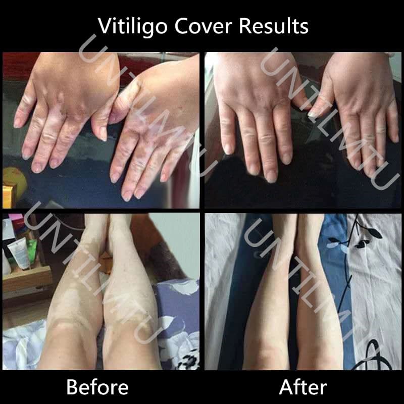 Impermeabile pelle vitiligine copertura correttore penna lunga durata donna uomo bianco Patch viso macchie corpo copertura trucco
