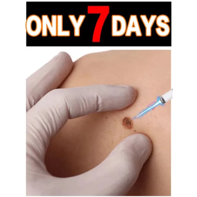 Blue light pen quickly removes warts, a best-selling wart care tool.