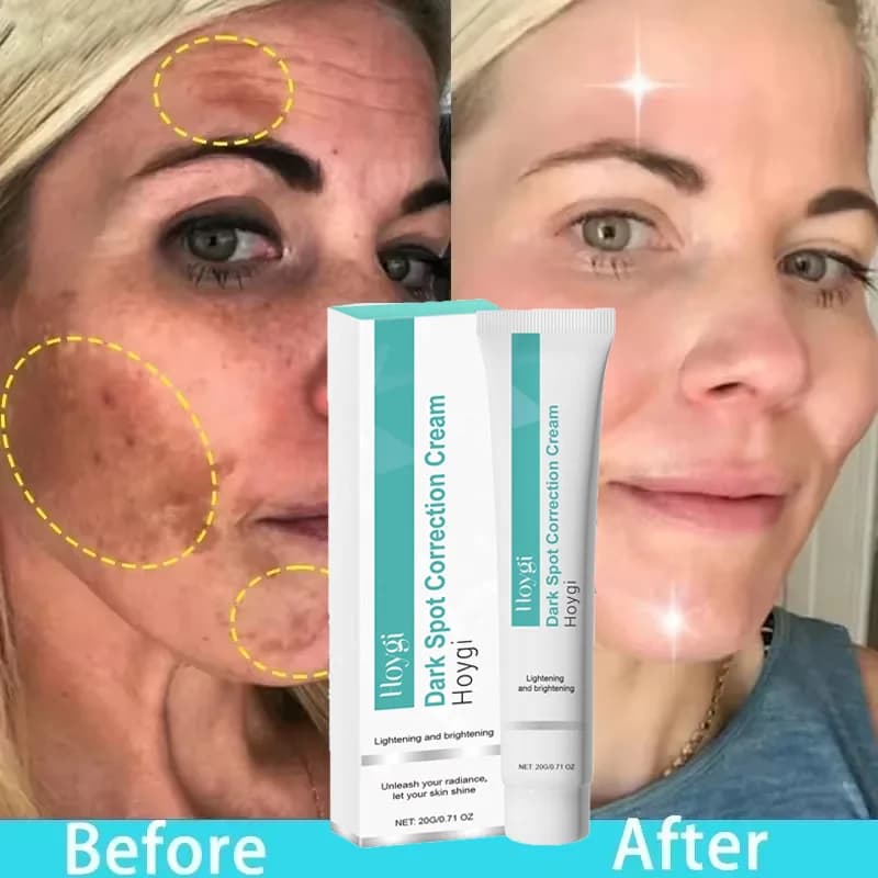 Powerful Anti-Macchie Whitening Cream, Removes Melasma and Macchie Scure, Reduces Pigmentation and Acne, Hydrating and Skin Care