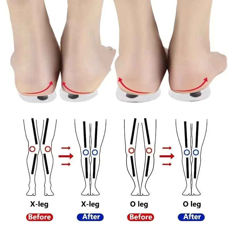 1 pair of orthopedic soles for feet O/X type leg correction valgo men gel silicone shoes inpiede magnet massage shoes tablets