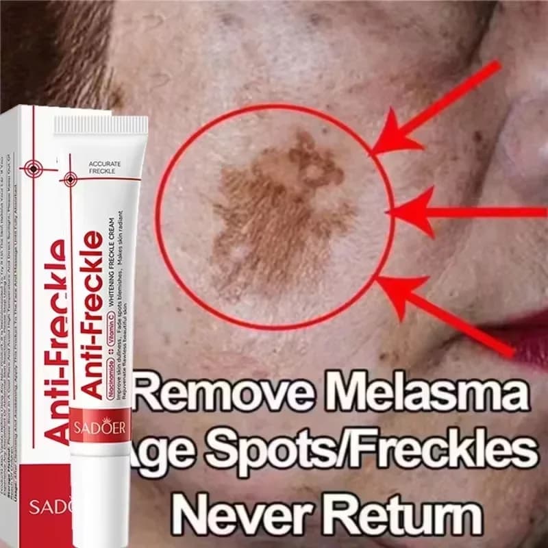 Efficace Sbiancamento Lentiggine Crema per il viso Correttore per macchie scure Rimuovere il melasma Dissolvenza Pigmentazione della melanina Illumina i prodotti per la cura della pelle
