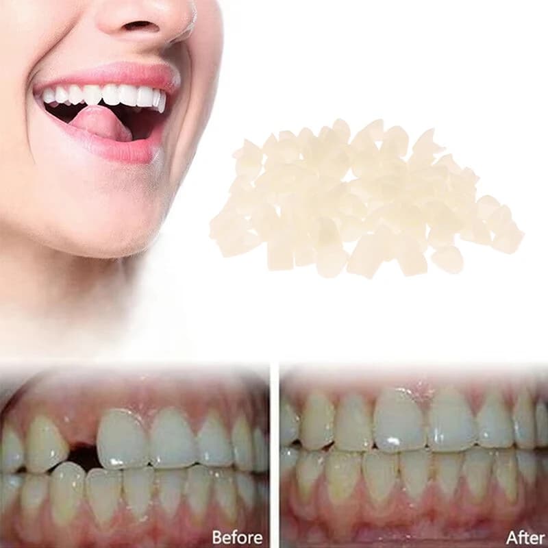 1 Confezione di Materiale per Corone Dentali Provvisorie per Denti Anteriori e Molari, Protezione Gengivale, Qualità Stabile