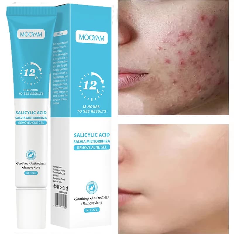 Crema per l'acne per il viso, trattamento per la rimozione dei brufoli, restringimento dei pori, controllo dell'olio, schiarimento delle macchie dell'acne, sbiancante, levigante, cura della pelle del viso