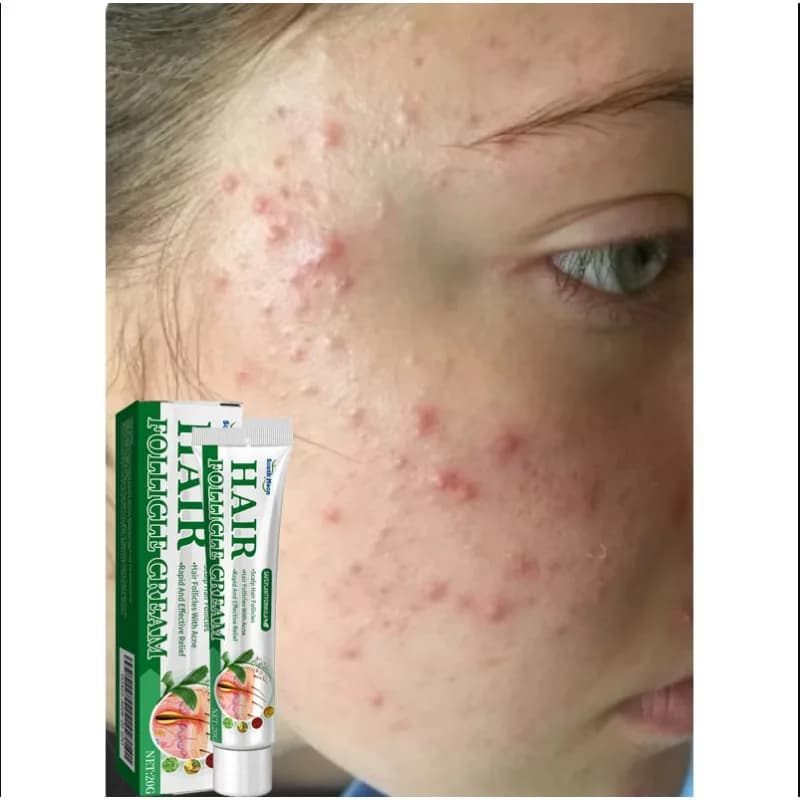 Anti-Acne Cream Effectively Removes Skin Nodules Pustule Cysts Papuli Black Points Men and Women Acne Essence Cream for Skin Care