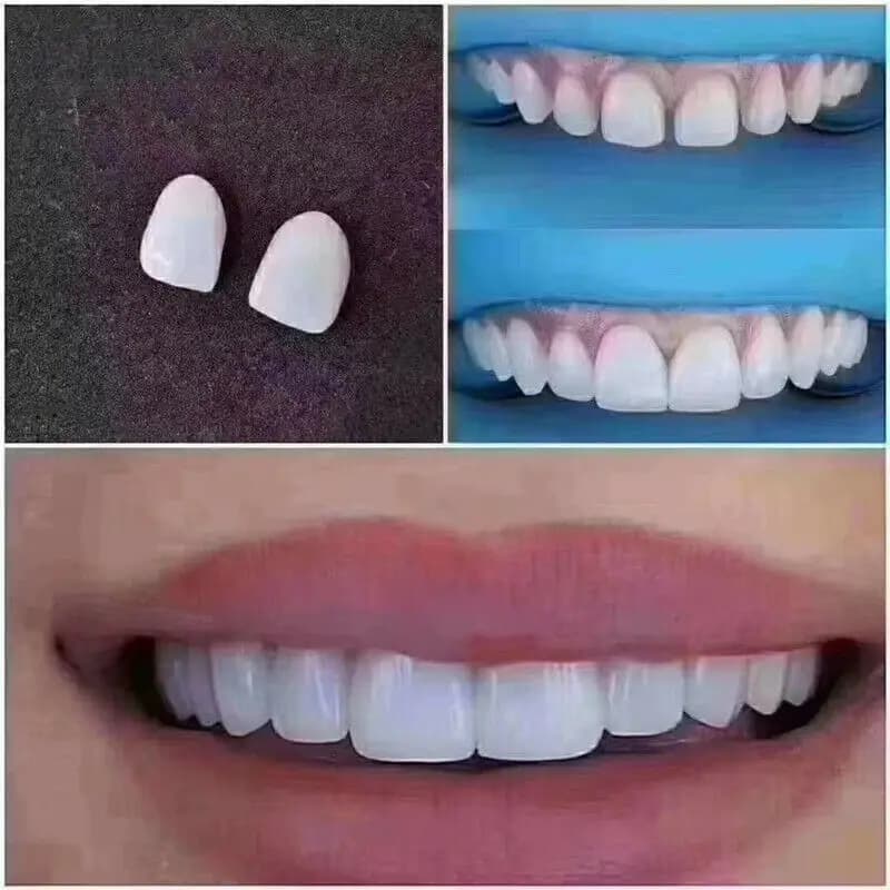 2 pezzi No.31 # impiallacciature dentali sbiancamento dei denti impiallacciature di denti professionali in ceramica bianca brillante