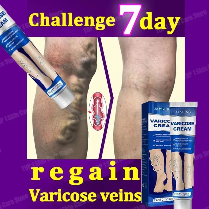 Treatment of varicose veins for legs | Cream with spider veins and varicose veins | Protein with collagen