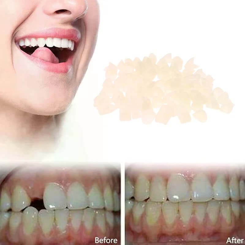 1 Confezione Materiale per Corone Dentali Provvisorie, Faccette in Resina per Denti Anteriori e Molari, Kit di Riparazione Dentale Temporanea, Protezione Gengivale