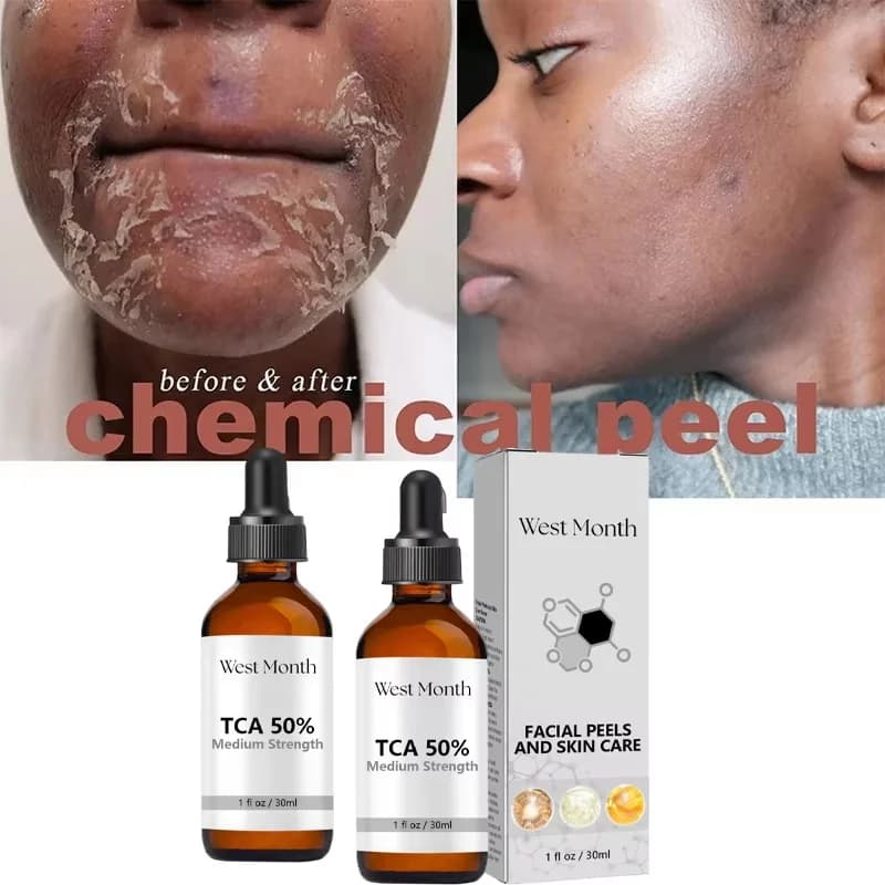 Acid Peeling Serum Chemical Exfoliant Peel For Remove Face Dark Skin Spots Whiten Lighten Melanin Peeling Solution Skin Peel