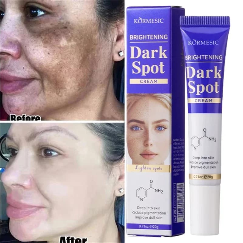 Cream for removal of dark spots Face whitening Lentiggine Acne Sign Removal of pigmentation Correction of melanin skin Lighting products for care