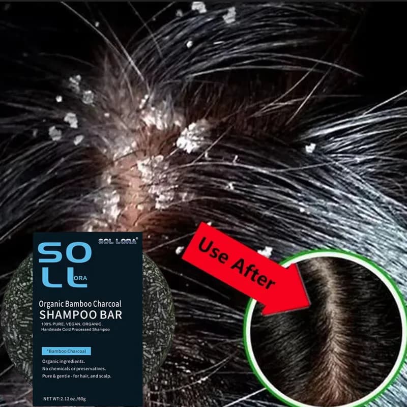 Fast Anti Dandruff Hair Treatment Soap Itching Repair Scalp Cleaning Exfoliating Products Oil Control Antipruritic Hair Care