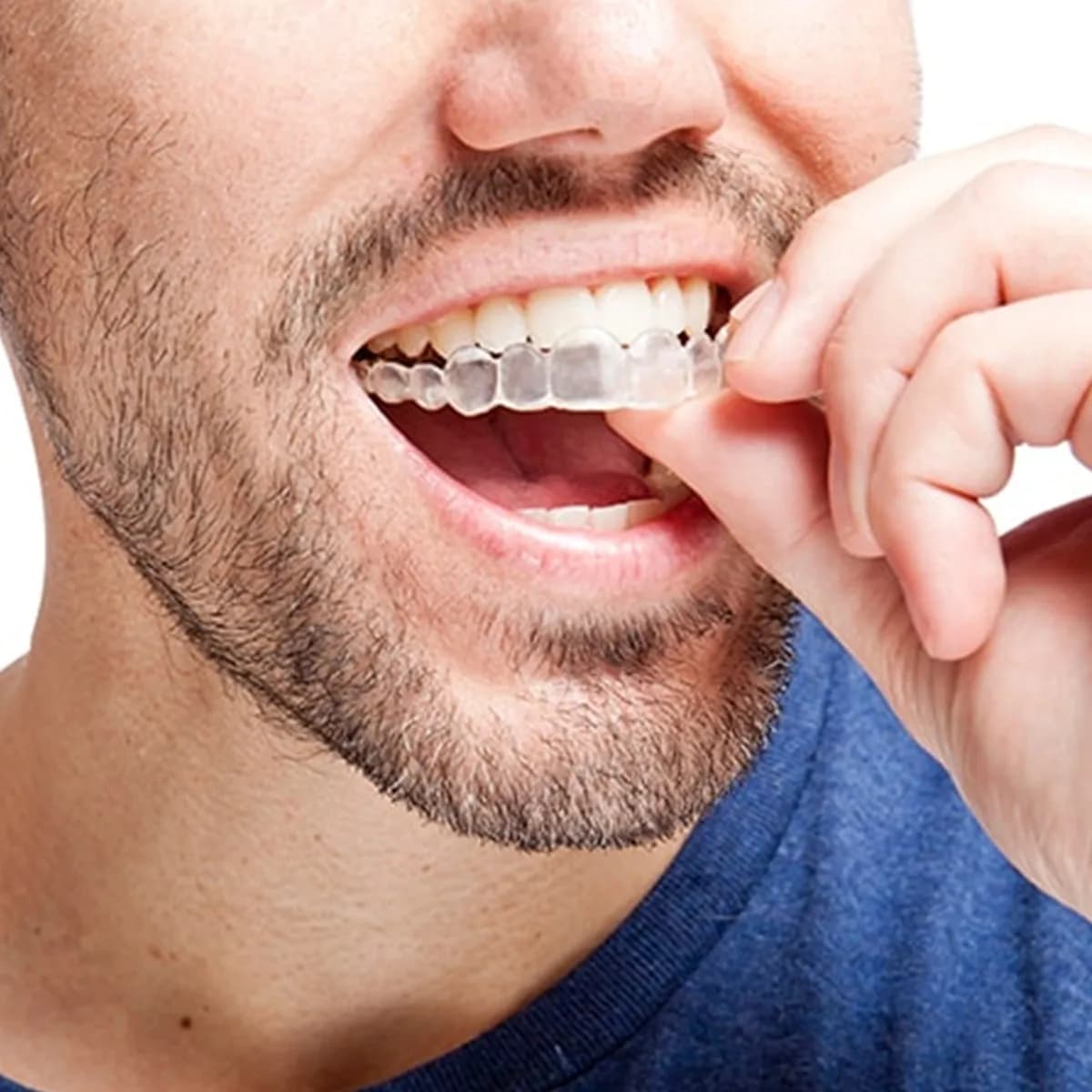 Invisalign Thermoforming Dentale Oral Laboratory Hygiene Clenching Straightening Tooth Whitening Bocca Guard Care Tool