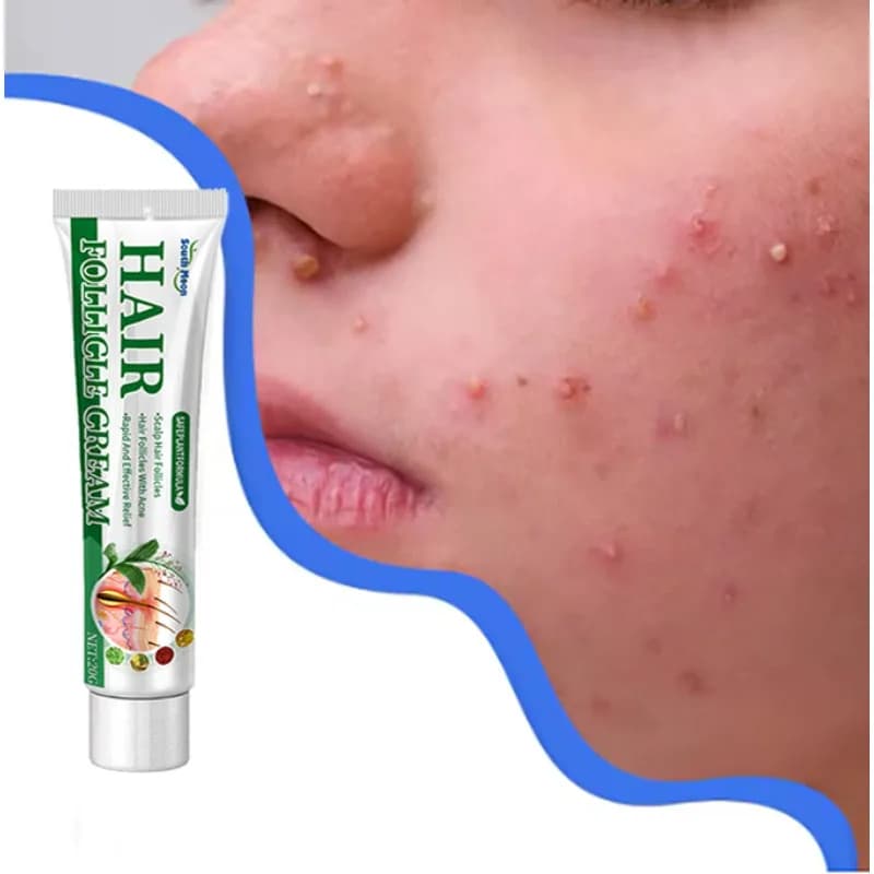 Liquido confortevole per la rimozione dell'acne in 7 giorni, migliora l'acne, pratica soluzione riparatrice per il viso, prodotti delicati per la cura della pelle