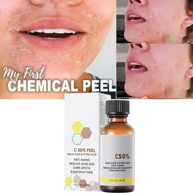 Con acido malico e acido citrico per la buccia del viso 40% siero peeling siero peeling buccia chimica sbiancante essenza nutriente