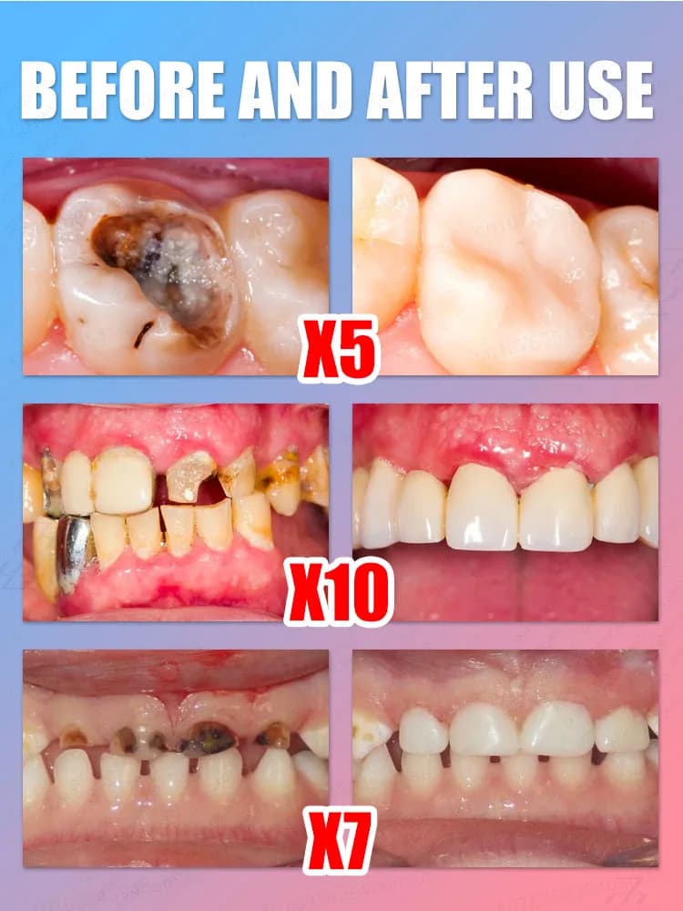 99% ha visto i denti più bianchi! Dentifricio Sbiancante Testato dal Dentista - Luminoso Visibile nei Giorni