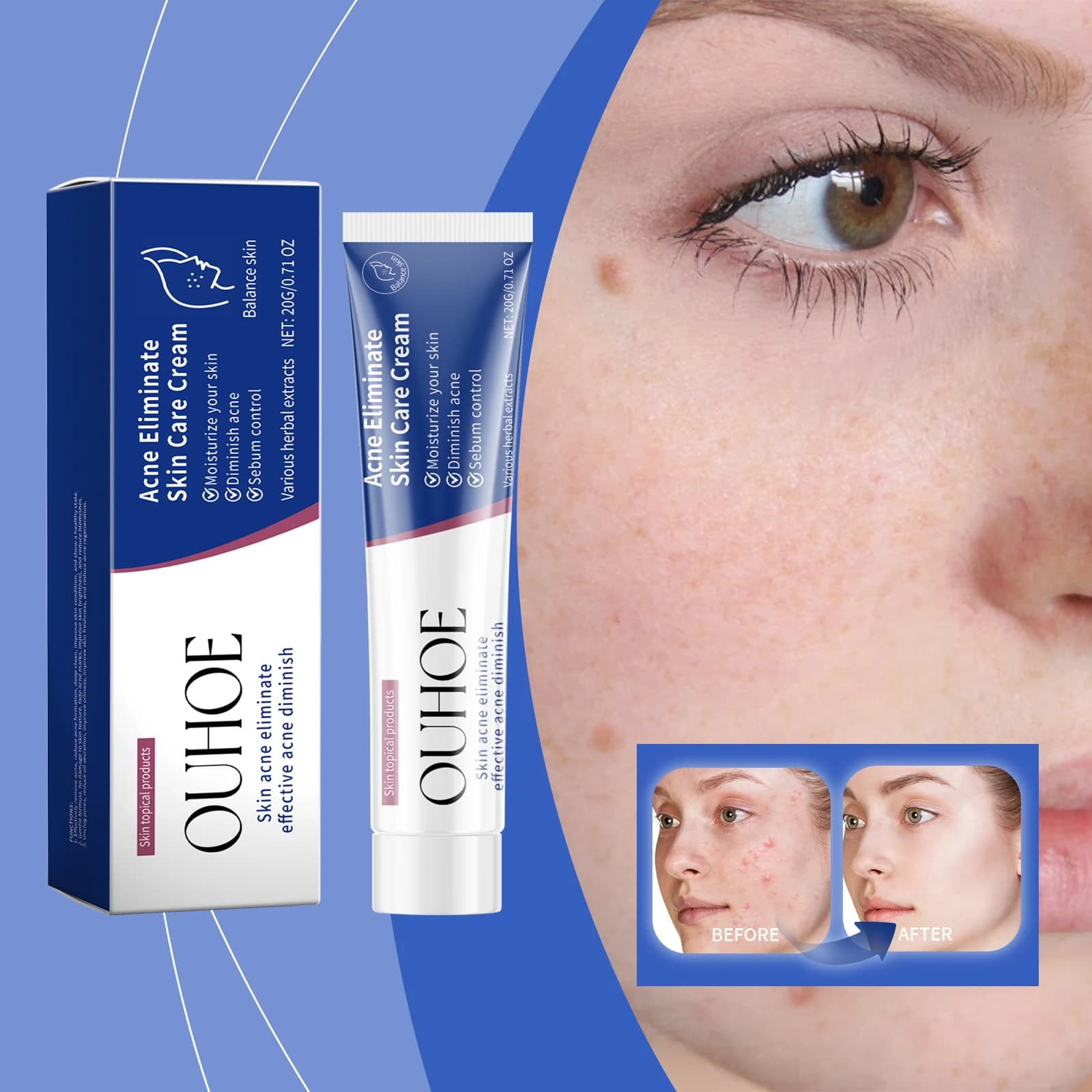 Crema Viso per il Trattamento dell'Acne, Nutriente, Riequilibrante, Controllo del Sebo, Rinfrescante, Riparatrice, Rimozione Brufoli, Crema Detergente Anti-Acne