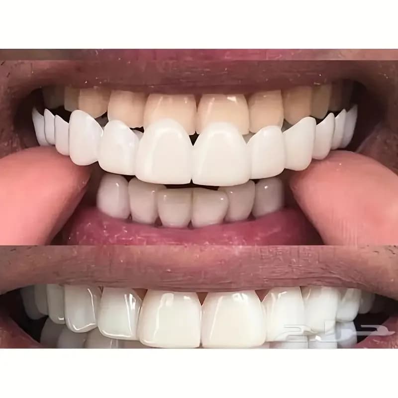 Faccette Dentali Sbiancanti Senza Colla a Incastro, Riutilizzabili, Temporanee, per un Sorriso Naturale, per Uomini e Donne, Uso Quotidiano ck848
