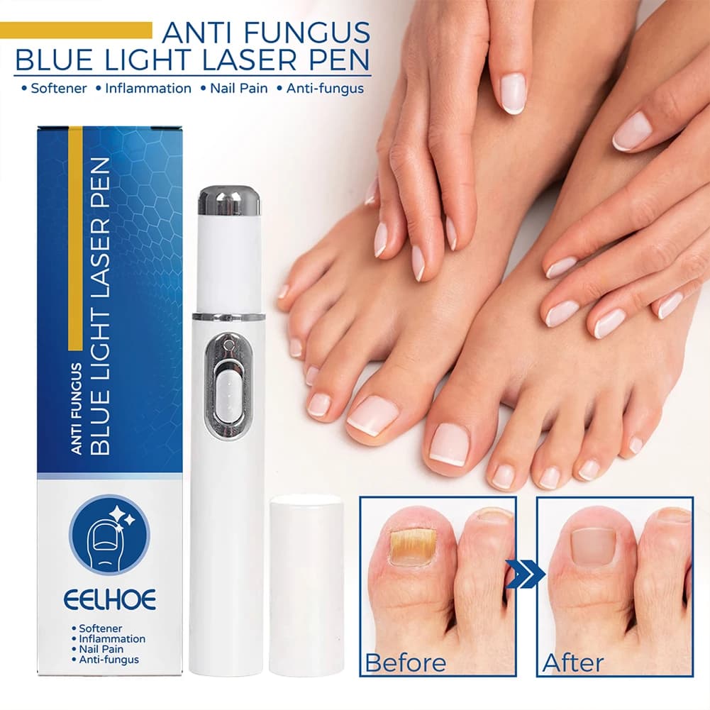 Hot Nail fungino Pen Anti Fungus Blue Light Repair Pen onicomicosi rimozione portatile indolore siero Gel prodotti per la riparazione dei piedi