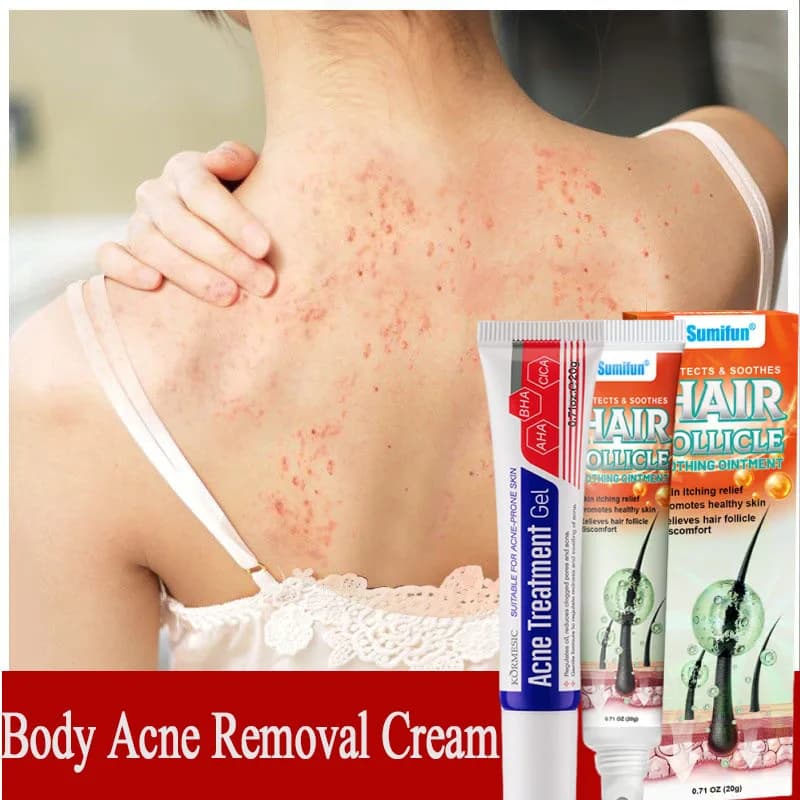 Crema per la rimozione dell'acne del corpo Trattamento Viso Glutei Schiena Segni dell'acne Riparazione liscia Crema per la pelle di pollo Idratante Sbiancamento Cura della pelle