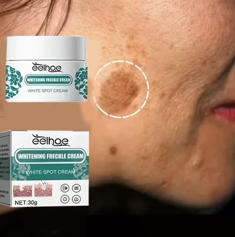 Crema Schiarente Delicata al Niacinamide per Melasma, Sbiancante Efficace contro la Melanina, Rimuove i Pigmenti Scuri, Idratante per la Cura della Pelle