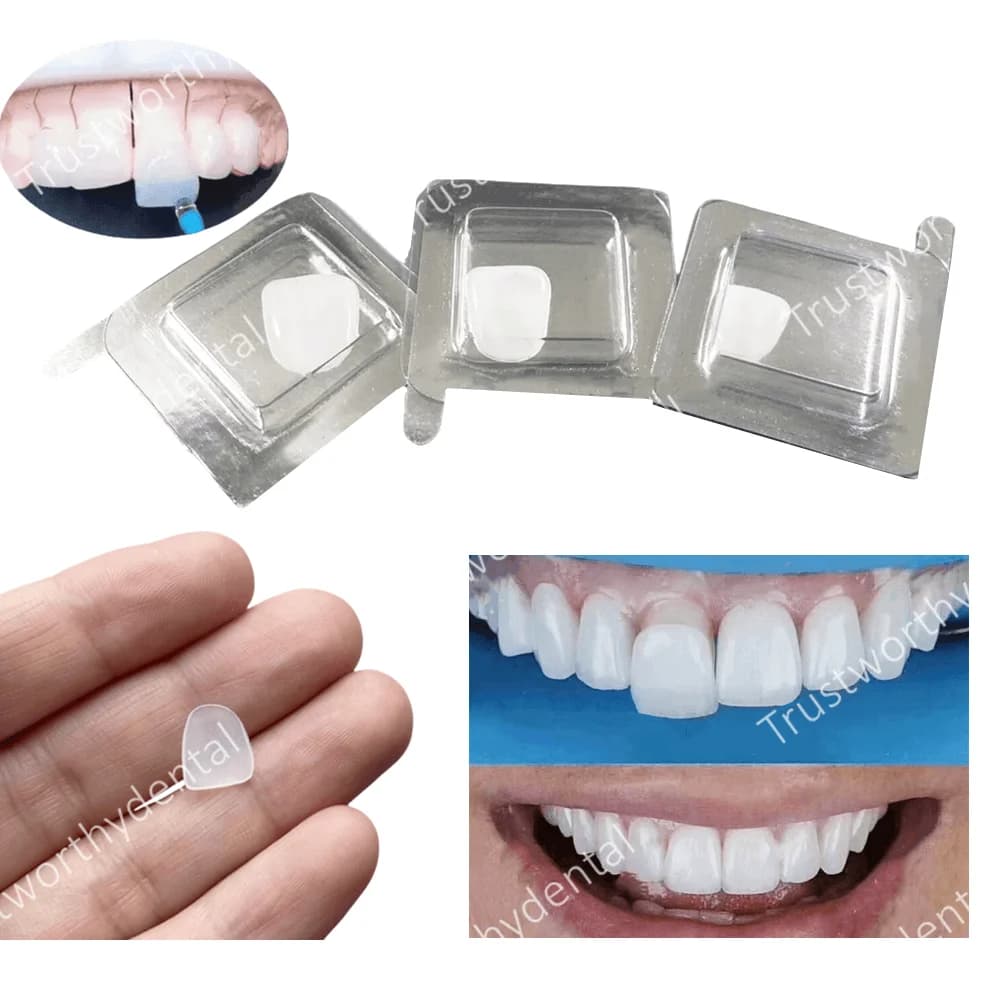 Dental composite porcelain veneer Front teeth whitening Lower upper veneers Materials for the restoration of bright white dentistry