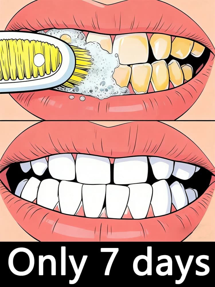 Generazione 2 2026, Strumenti per la cura a caldo a forma di mousse per la placca dentale, adatti per 7 giorni