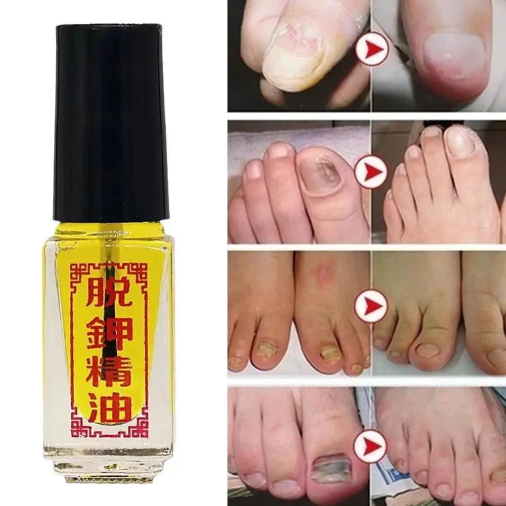 5ml Trattamenti per funghi delle unghie Unghie delle dita dei piedi Gel per la rimozione dei funghi Anti-infezione Olio per funghi delle dita dei piedi Onicomicosi del piede della mano Effetto rapido