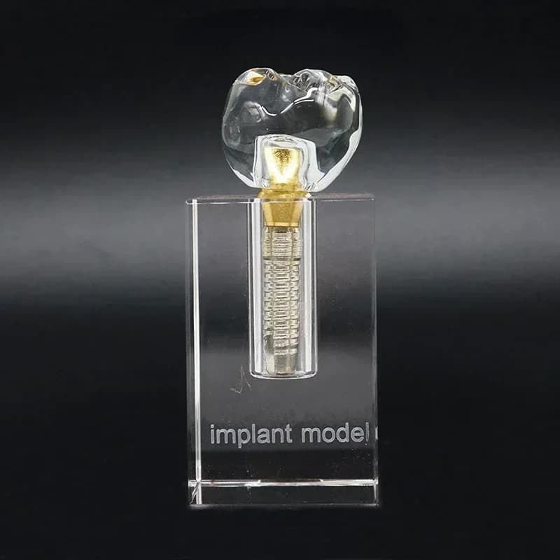 Sovdenture superiore/inferiore mandibolare interno rimovibile con impianti Modello di denti dentali per lo studio didattico