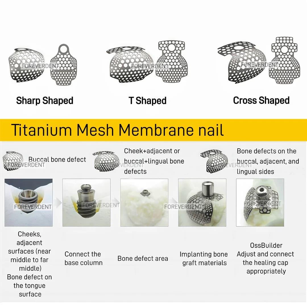 1PC Dentale 1/2/3 Parete Maglia di Titanio GBR Osso Impianto Dentale Maglia di Titanio Rigenerazione Ossea Chiodi Membrana Flessibile e di Sicurezza