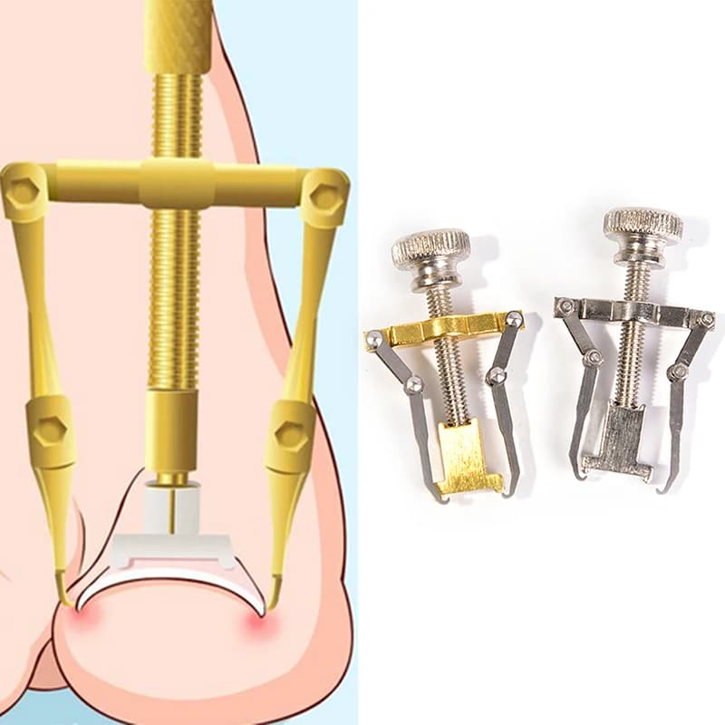 1 Pezzo Strumento Professionale per Correzione Unghie Incarnite, Pedicure e Arte Ortopedica delle Unghie