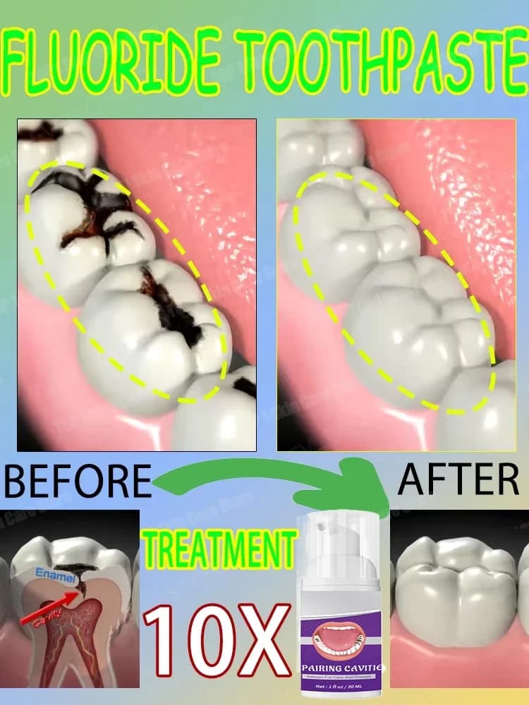 Tooth whitening toothpaste Repair tooth caries Removal plaque Macchie Repair tooth decay Tooth treatment Dental calculator9273