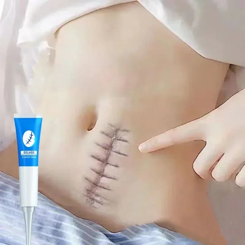 Gel crema per cicatrici riparazione efficace cicatrici chirurgiche smagliature pozzi per l'acne tasche bruciare cicatrici trattamento di riparazione