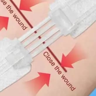 Cerniera Cravatta Chiusura della ferita Patch Cerniera Cerotto Ferita Sutura rapida Patch emostatico portatile per esterni Strumento di primo soccorso