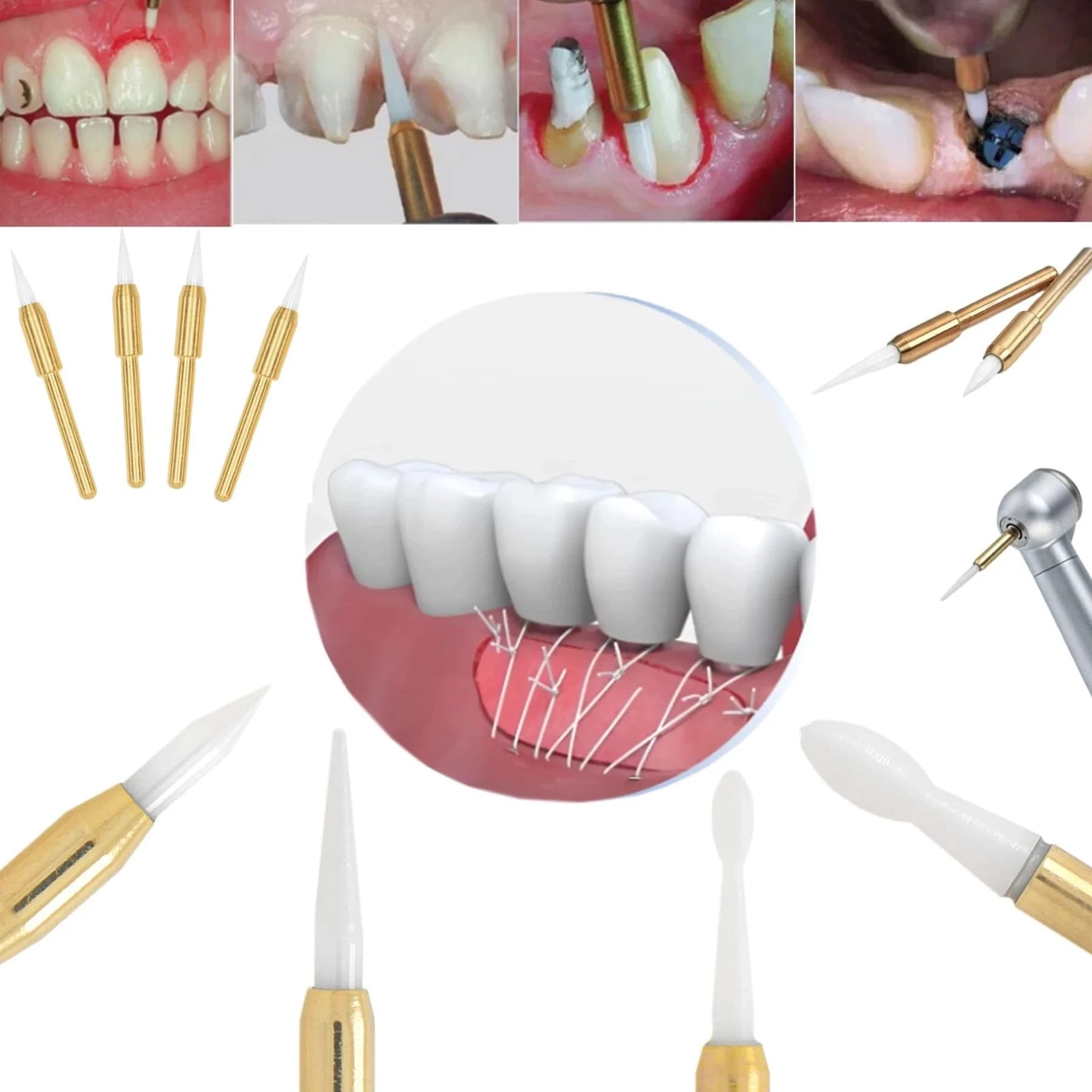 Frese Chirurgiche Dentali FG per Tessuti Molli, Frese in Ceramica per Taglio Preciso Gengivale, Sbiancamento Denti