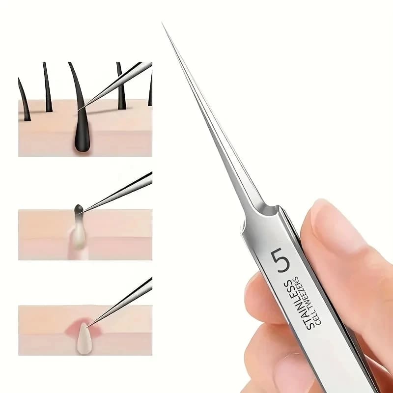Set di estrattori per acne in acciaio inossidabile facile da usare: pinzette di bellezza ipoallergeniche per una pelle chiara, perfette per i principianti