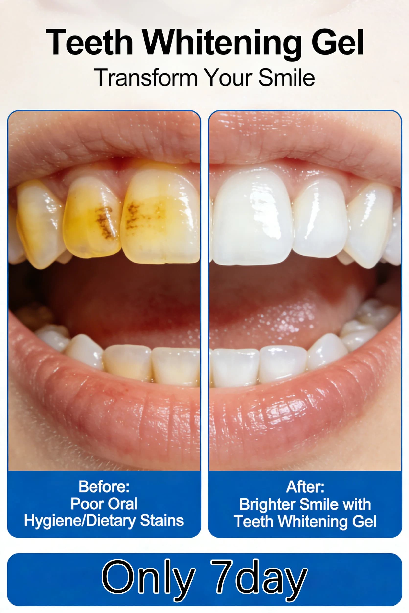 Kit Gel Sbiancante per Denti a LED – Rimozione Macchie in 7 Giorni, Cura Orale per un Sorriso Bianco Brillante, Bellezza e Salute