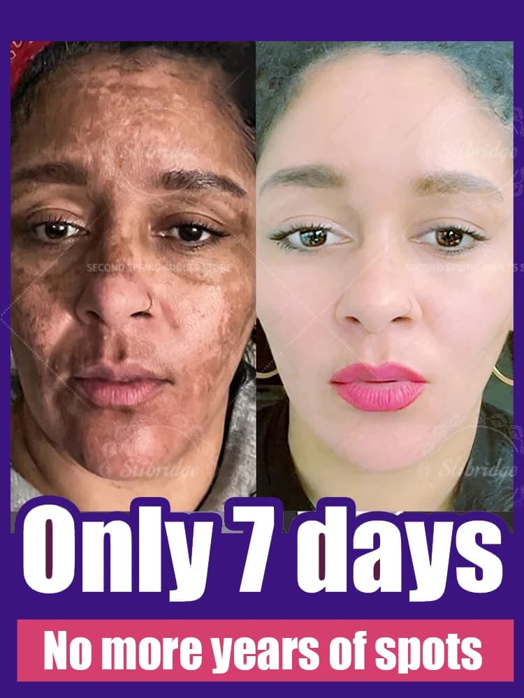 Potente crema schiarente veloce per la pelle Risolvi macchie scure del melasma Adatto a tutte le età