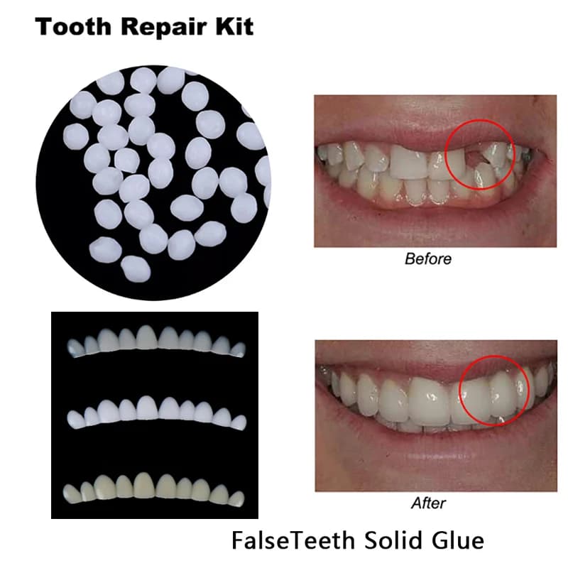 Kit di riparazione temporanea dei denti fessure dei denti Falseteeth colla solida adesivo per protesi