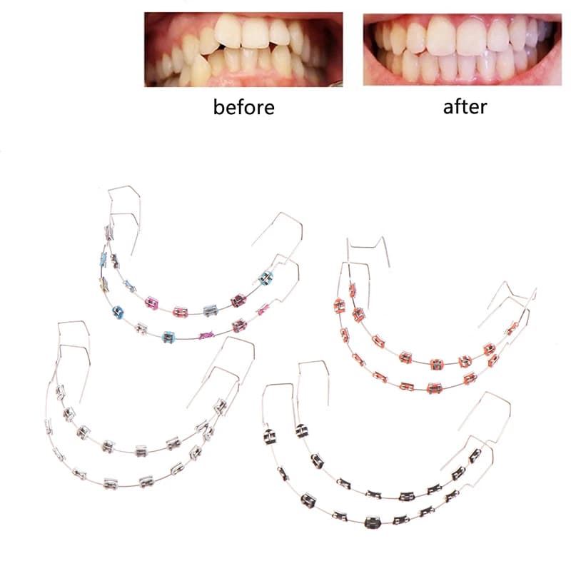 1 paio di decorazioni temporanee colorate per denti con fili metallici, staffa metallica e legature ortodontiche, decorazioni dentali