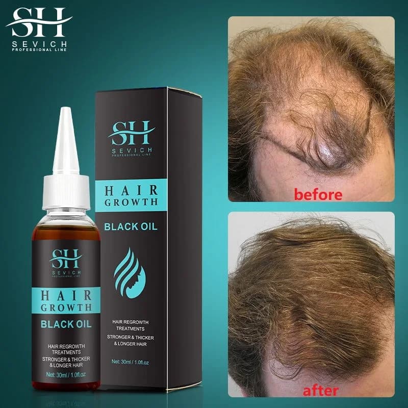 Sevich olio essenziale di germe di zenzero naturale cresce efficacemente e rapidamente ammorbidisce la cura dei capelli previene la caduta dei capelli olio essenziale 30ML