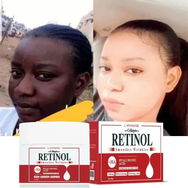 Crema sbiancante viso corpo retinolo collagene acido ialuronico 3 in1 rimuovere le macchie scure eliminare la melanina dissipare l'acne schiarire la pelle