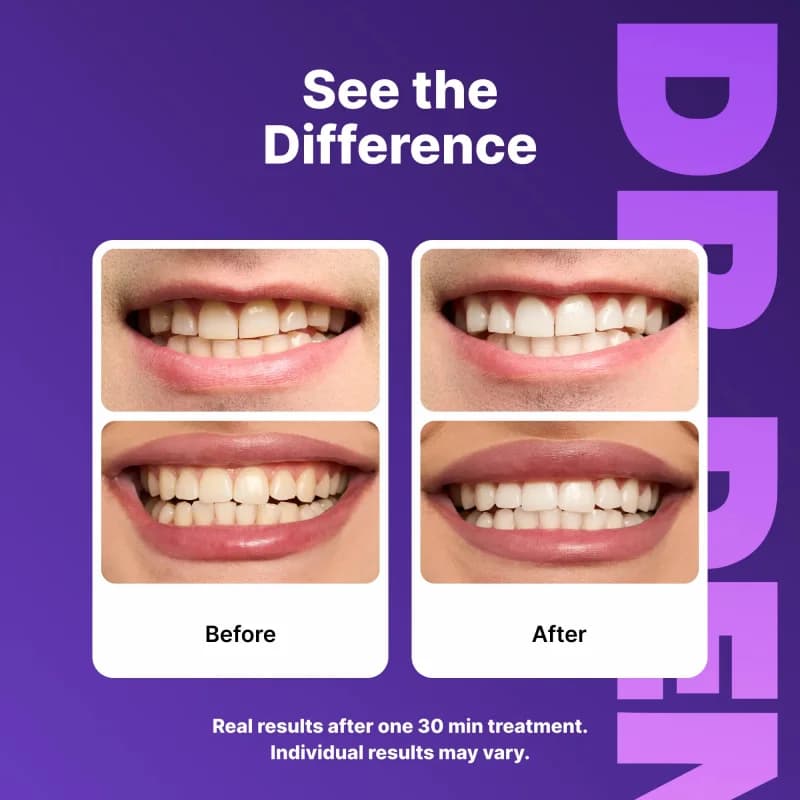 DRDENT Purple Teeth Whitening Strips 7 Treatments Peroxide Free Non Sensitive Teeth Brightening Stain Remover Oral Beauty Care