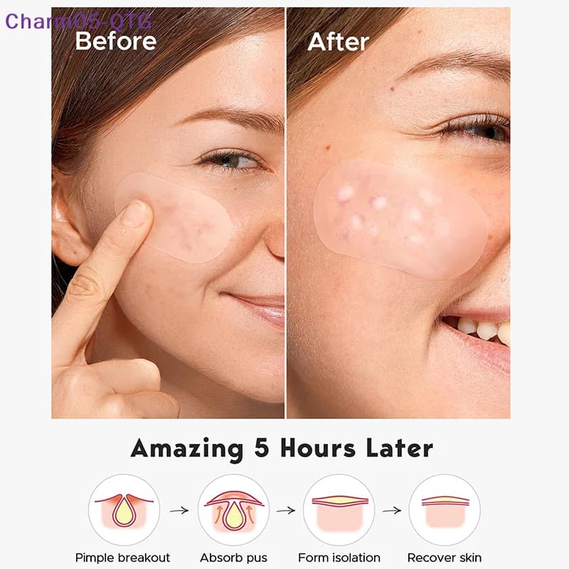 NUOVO 40 pezzi rimozione brufolo invisibile cerotti anti-acne macchie segni correttore bellezza