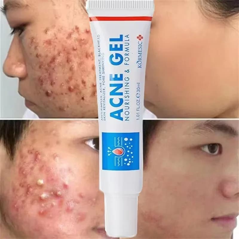 Acido salicilico Trattamento dell'acne Crema per il viso Riparazione Macchie di brufoli Pulizia profonda dei pori Anti-acne Cicatrice Controllo del petrolio Idratante Cura della pelle