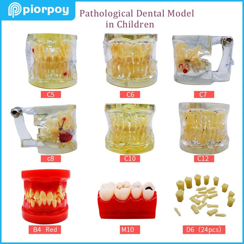 Dentale patologico Typodont denti stampo parodonzia endodonzia carie bambini odontoiatria insegnamento studente studiare modello di denti