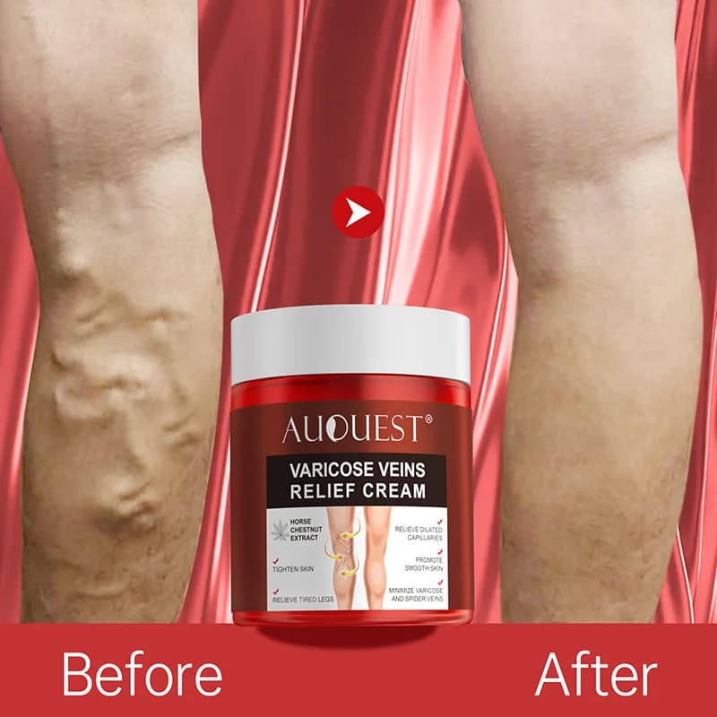 Auquest Ointment for Vene Varicose Eliminates Vasculite Flebite to Relieve The Treatment of Pain to the Gambe of Spider Cream Herbs 80g