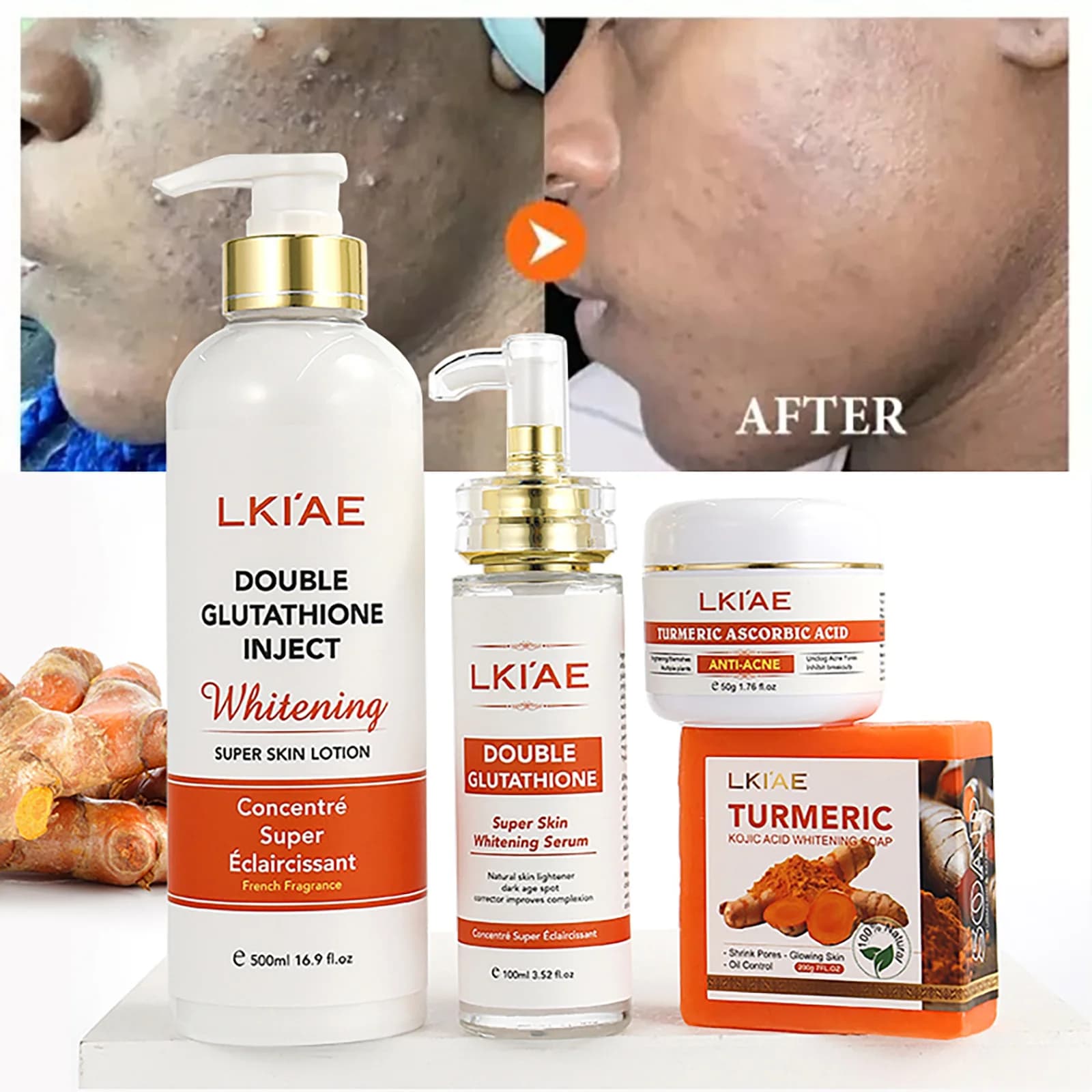 AILKE Set per la cura della pelle sbiancante e rimozione dell'acne, con glutatione, vitamina C, aloe vera, idrata, evende il tono della pelle