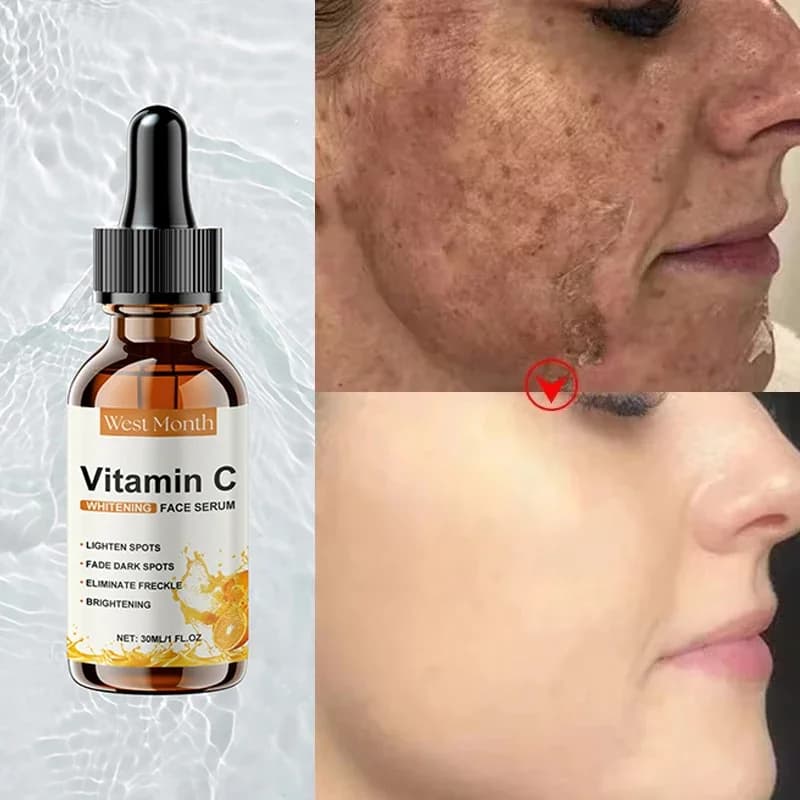 Vitamin C Whitening Serum Remove Freckles Dark Spots Face Essence Fade Melasma Melanin Brighten Repair Dull Skin Care Cosmetics