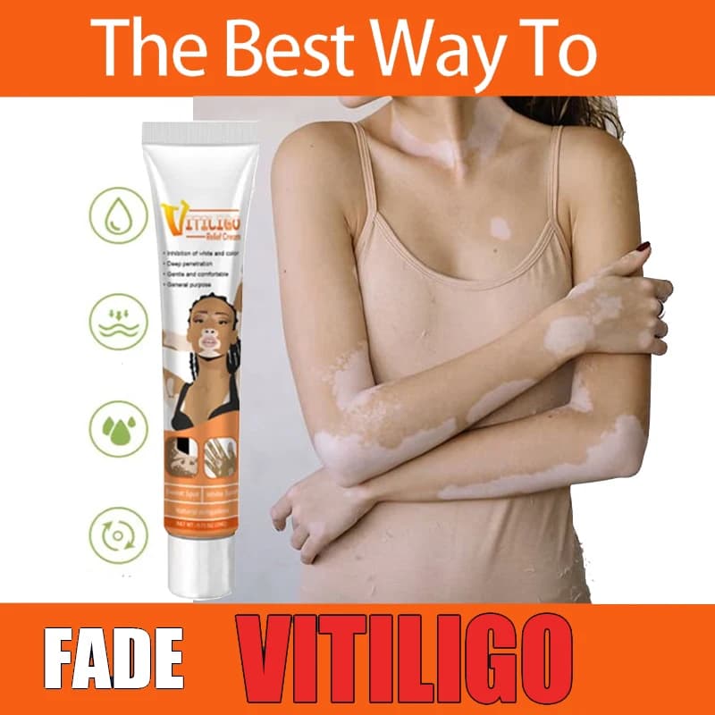 Unguento per vitiligine Tigna Rimuovi efficacemente la rimozione delle macchie bianche Pelle Vitiligine Elimina la vitiligine Cura della pelle del corpo