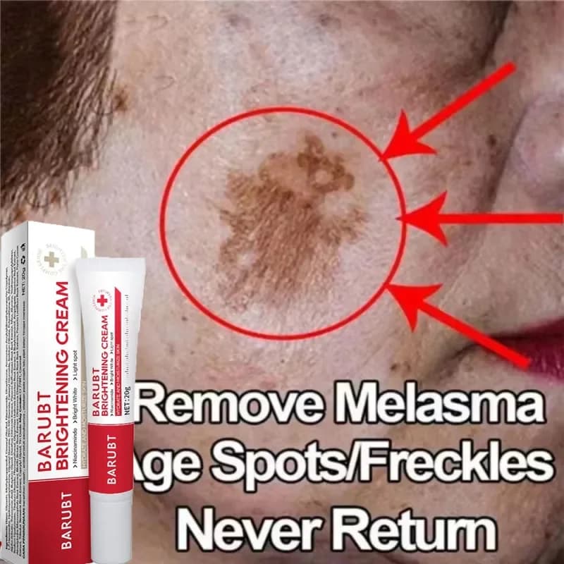 Potente crema sbiancante per la rimozione delle macchie Illumina la pelle Elimina rapidamente la pigmentazione della melanina Melasma Macchie scure Cura della pelle coreana