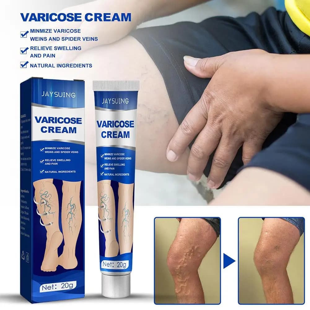 unguento per vene varicose Crema efficace per alleviare le vene varicose per alleviare la vasculite delle gambe, la flebite, il trattamento del dolore al ragno K4Z1
